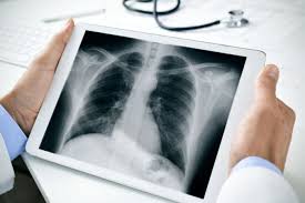 Cara yang mudah untuk mengobati paru paru basah ini yaitu dengan minum air putih secukupnya. Klinik Kardio Respirasi Klinik Dokter Tht Di Malang Klinik Dokter Paru Di Malang Klinik Jantung Di Malang Klinik Dokter Paru Di Surabaya Klinik Dokter Penyakit Dalam Di Malang Klinik Dokter Gigi Di