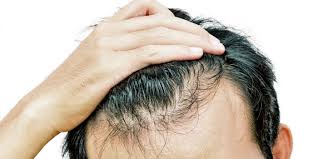 Nonostante si tratti di un fenomeno del tutto fisiologico, . Perdita Dei Capelli La Guida Di Trapiantocapelliroma Com Trapianto Capelli Roma