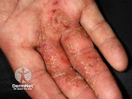 Image result for Hand Infection
