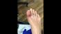 Ingrown Hair On Big Toe