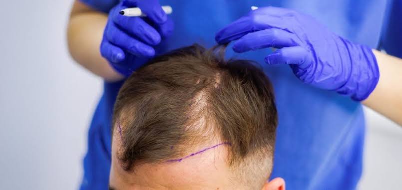 FUE Hair Transplant: Procedure, Cost And Benefits