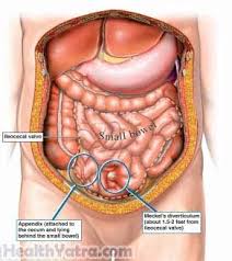 As a rule, the cancer develops from benign formations that can grow in this part of the body. Meckel S Diverticulum Definition Causes Symptoms Complications And Cost Surgery Treatment Hospital In India