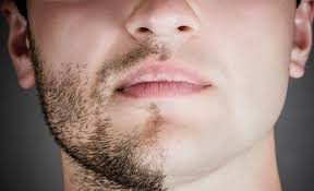 laser hair removal services for men