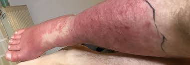 Image result for erysipel photos)