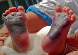 Purpura fulminans is an acute purpuric rash characterized by coagulation of the microvasculature, which leads to purpuric lesions and skin necrosis. Neonatal Purpura Fulminans Due To Protein C Deficiency Adc Fetal Neonatal Edition