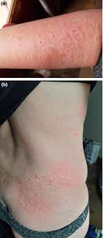 Track marks (ie, intravenous drug abuse). Acute Urticaria With Pyrexia As The First Manifestations Of A Covid 19 Infection Damme 2020 Journal Of The European Academy Of Dermatology And Venereology Wiley Online Library