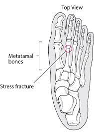 Stress Fractures of the Foot - Injuries and Poisoning - Merck Manuals Consumer Version