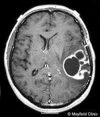 While ct scans are widely available and produce images rapidly, mri scans provide better anatomic detail of brain structures and detection of the sample is analyzed by a pathologist or neuropathologist to determine whether the tumor is benign or malignant and identify the type of tumor. Brain Tumor Ct Scan Pictures Google Search