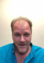 Male Pattern Hair Loss Treatment in Georgia Muscogee Columbus