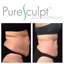 Puresculpt Ice Body Contouring After 10 Sessions Www Pureorganicice Com Body Treatments Body Contouring Body Sculpting