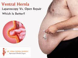 Check spelling or type a new query. Ventral Hernia Laparoscopy Vs Open Repair Which Is Better