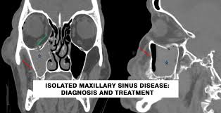 Image result for Maxillary Sinus