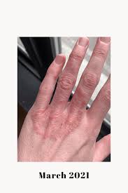 Learn how to pronounce dyshidrotic eczema with the american pronunciation guide (apg)! Pompholyx Eczema Fingers Pictures