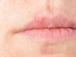 Einleitung bläschen im mund sind ein häufiges phänomen, welches bei kindern und erwachsenen gleichermaßen auftritt und ein symptom unterschiedlicher erkrankungen sein kann. Herpes An Lippen Oder Nase Richtig Behandeln Ndr De Ratgeber Gesundheit
