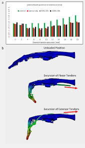 Image result for Elson Extensor Tendon Test