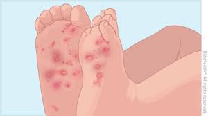 Psoriasis is a skin condition that can sometimes cause a rash on the hands and feet. Scabies For Parents Nemours Kidshealth