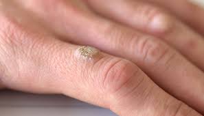 Verruga E Contagiosa Tipos Riscos E Como Eliminar Vix
