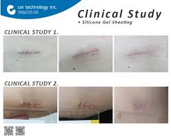 It has the ability to bind to a variety of harmful and. Medical Disposable Product Silicone Gel Sheeting Taiwantrade Com