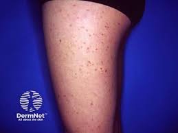 Image result for Urticaria pigmentosa children