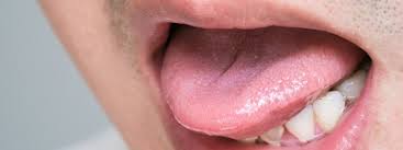 Image result for Puchýře na jazyku