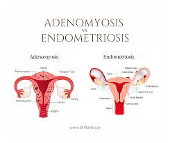 Postmenopausal endometriosis and malignant transformation of endometriosis: Dr Marlin Mubarak Posts Facebook