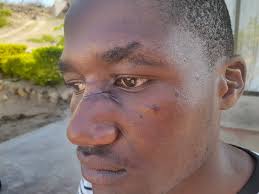 One of us was going to die': Man fights off leopard with his bare hands