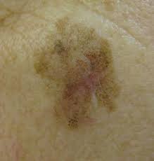 Image result for Solar Lentigo