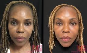 Skin debridement can be harmful to the body's ability to recover and develop new skin , this is why i'd suggest you to help the damaged skin asap. African American Skin Treatment Dermatology Nyc Dr Michele Green M D