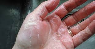 Staph infections—including those caused by mrsa—can spread in hospitals, other healthcare facilities, and in the community where you live, work, and go to school. To Prevent Mrsa In Hospitals Don T Prevent Only Mrsa Wired
