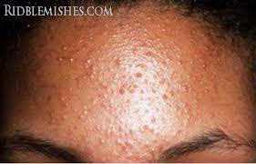 How To Prevent Forehead Acne Posts By Sara Taylor Forehead Acne Small Bumps On Forehead Forehead Bumps