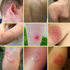 Image result for infected tick bite