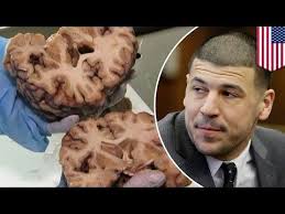 Research Shows Aaron Hernandezs Brain Had Severe Damage With Signs Of Cte Tomonews Boston Massachusetts A Research Conducted By Boston Universitys Cte Center