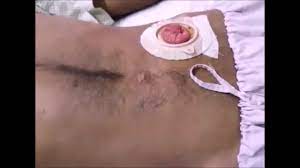 Obstetric fistula is a childbirth injury that destroys a woman's life. File Fistula What Is Fistula In Ano Anal Fistula Webm Wikimedia Commons