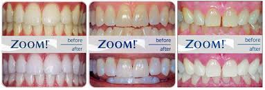 Philips Zoom Teeth Whitening Bleaching Advancements In