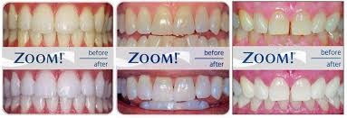 philips zoom teeth whitening bleaching advancements in