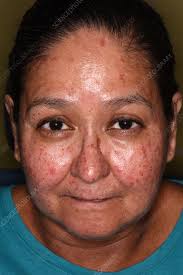 Image result for Connective Tissue Disorder