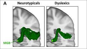 So why do people use the term instead of just saying dyslexia? Diving Deeper Into Developmental Dyslexia Eurekalert Science News