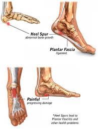 What can cause a bone spur on foot? Bone Spurs Symptoms Causes And Treatments In Dallas Plano Texas