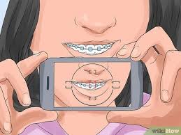 So i'm asking anyone who has had or has braces, how long did the elastics take once you started them? How To Prepare For Getting Braces Removed 12 Steps