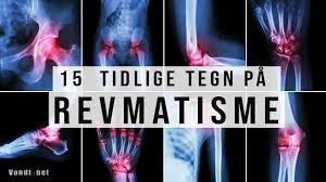 Patellofemorale smerter er den mest vanlige årsaken til knesmerter, men andre grunner til smerter i knærne er artrose i kne kronisk leddlidelse på grunn av slitasje av leddbrusken i kneet. Vondt Pa Utsiden Av Kneet Arsak Diagnose Symptomer Og Behandling