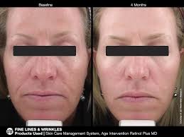 Microscopic sponge encapsulation system provides a silky matte surface that does not feel heavy or oily. Jan Marini Age Intervention Retinol Plus Uneven Skin Texture Serious Skin Care Retinol