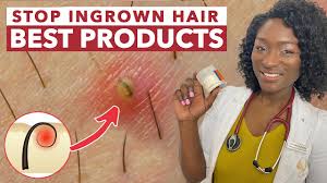 Male yeast infections, genital psoriasis and ingrown hairs are other potential causes of penile irritation. Stop Ingrown Hairs Best Products Razor Bumps Irritation Shaving Rash Hyperpigmentation Itch Youtube
