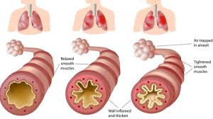 Image result for Inhalation Challenge Test
