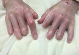 Image result for Systemic Sclerosis