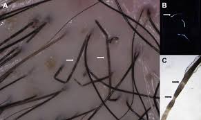 Blocked hair follicles symptoms begin with a lump that gradually becomes painful. The Dermoscopic Comma Zigzag And Bar Code Like Hairs Markers Of Fungal Infection Of The Hair Follicles Sciencedirect
