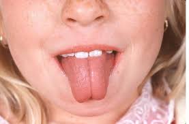Lengua Hinchada Causas Y Consecuencias