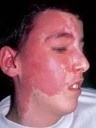 Vascular Malformations (I). Concept, Classification, Pathogenesis and  Clinical Features