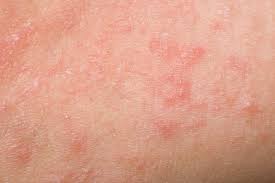 Image result for scabies in the groin area