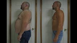 Before and after gastric bypass surgery pictures. Gastric Bypass Surgery Before And After 172lbs Weightloss Youtube