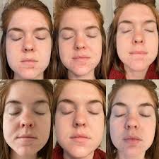 Benefits Of A Chemical Peel And What To Expect Lments Of Style Fashion Lifestyle Blog Chemical Peel Chemical Peel At Home Fashion Lifestyle Blog
